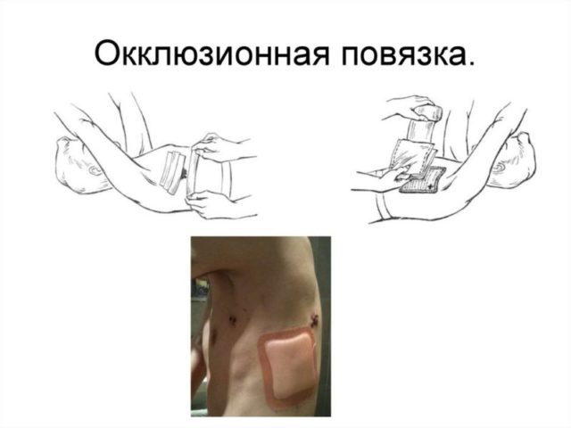 Основные задачи окклюзионной повязки: